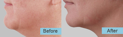 exilis-jawline-skintightening-Web-2