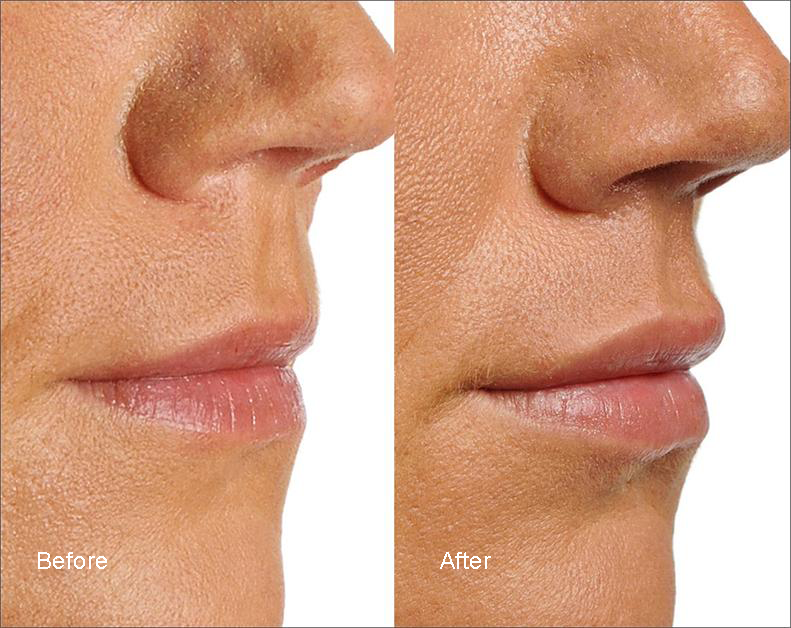 Volbella Now Available At the Derm Institute