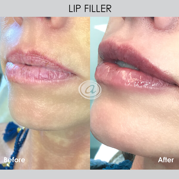lip filler before and after Dr. Chiu