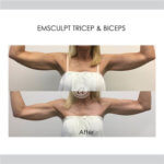 before and after emsculpt on triceps and biceps arm flexed position | Redondo Beach, CA