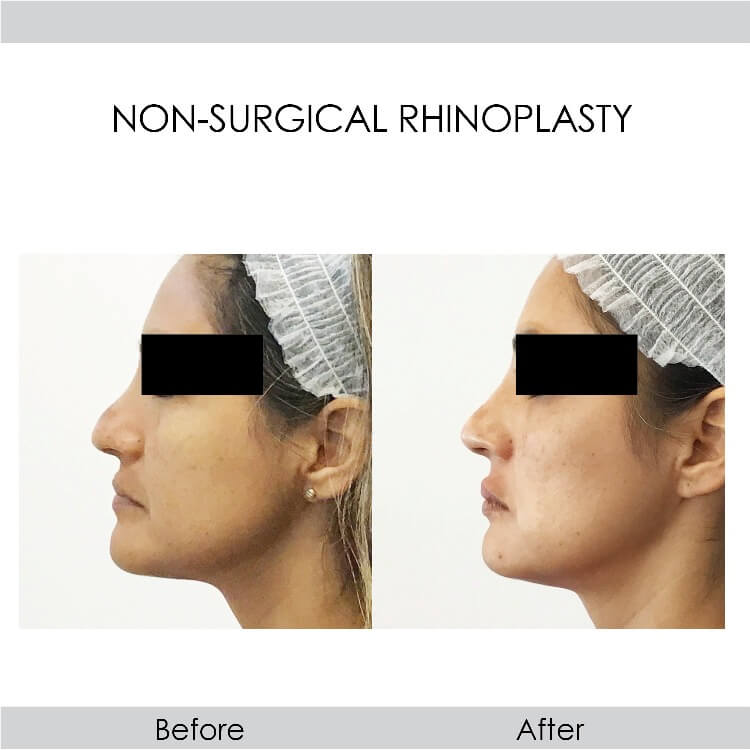 before and after non-surgical rhinoplasty female patient left side view | Redondo Beach, CA