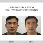before and after laser PRP and botox for lower face contouring front view | Redondo Beach, CA