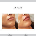 before and after lip filler female patient closeup view | Redondo Beach, CA