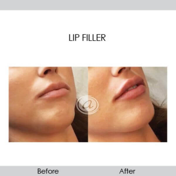 before and after lip filler female patient closeup view | Redondo Beach, CA
