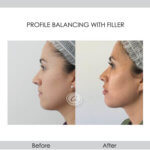before and after profile balancing with filler left side view | Redondo Beach, CA