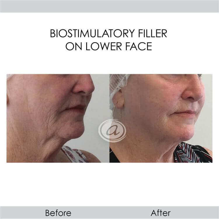 before and after biostimulatory filler on lower face female patient right angled view | Redondo Beach, CA