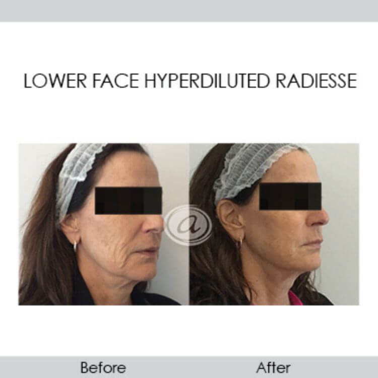 before and after lower face rejuvenation using fillers right angled view | Redondo Beach, CA