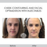 before and after cheek contouring and facial optimization with injectables | Redondo Beach, CA