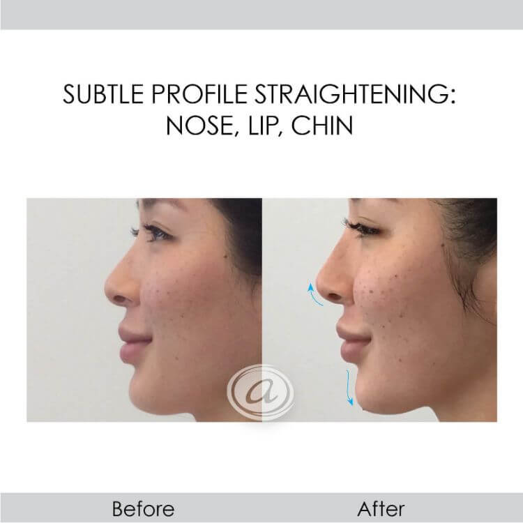 before and after profile straightening using fillers | Redondo Beach, CA