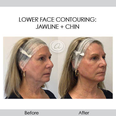 before and after lower face contouring right view female patient Redondo Beach, CA