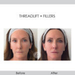 before and after threadlift and fillers front view female patient Redondo Beach, CA