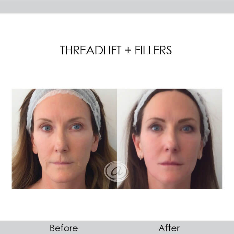 before and after threadlift and fillers front view female patient Redondo Beach, CA