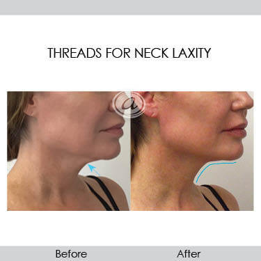 before and after threads for neck laxity right view female patient Redondo Beach, CA