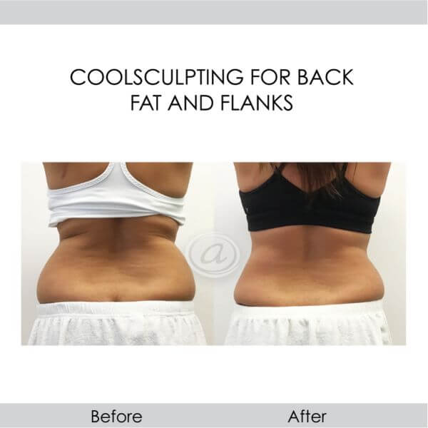 before and after coolsculpting for back fat and flanks back view female patient Redondo Beach, CA