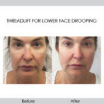 before and after threadlift for lower face drooping front view female patient Redondo Beach, CA