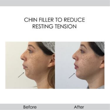 before and after chin filler to reduce resting tension left view female patient Redondo Beach, CA