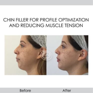 before and after chin filler profile optimization and reducing muscle tension left view female patient Redondo Beach, CA