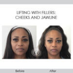 before and after lifting with fillers front view female patient Redondo Beach, CA