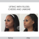 before and after lifting with fillers left view female patient Redondo Beach, CA