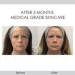 before and after medical grade skincare front view female patient Redondo Beach