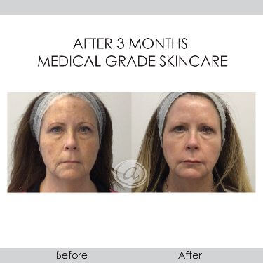 before and after medical grade skincare front view female patient Redondo Beach