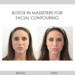 before and after botox in masseters for facial contouring front view female patient Redondo Beach