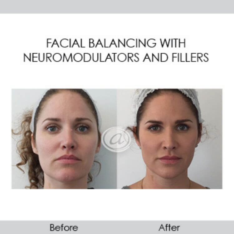 before and after facial balancing with neuromodulators and fillers front view | Redondo Beach, CA
