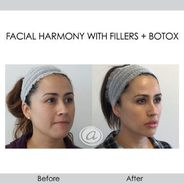 before and after facial harmony with filler and botox right view female patient Redondo Beach, CA