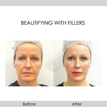 before and after beautifying with filler front view female patient Redondo Beach, CA