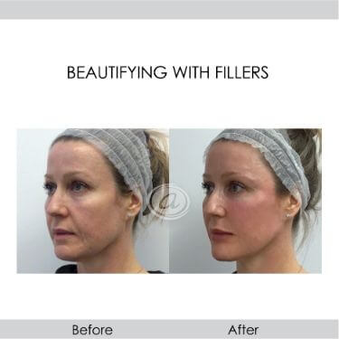 before and after beautifying with filler left view female patient Redondo Beach, CA