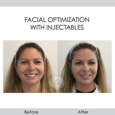 before and after facial optimization with injectables front view female patient Redondo Beach, CA