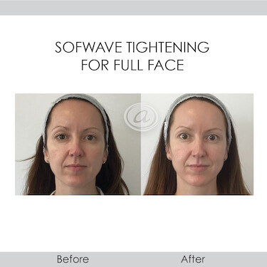 before and after sofwave tightening for full face front view female patient Redondo Beach