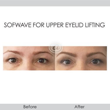 before and after sofwave for upper eyelid lifting front view female patient Redondo Beach