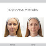 before and after rejuvenation with fillers front view female patient Redondo Beach