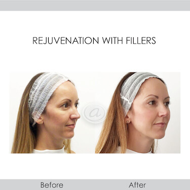 before and after rejuvenation with fillers right angle view female patient Redondo Beach