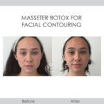 before and after facial contouring front view female patient Redondo Beach