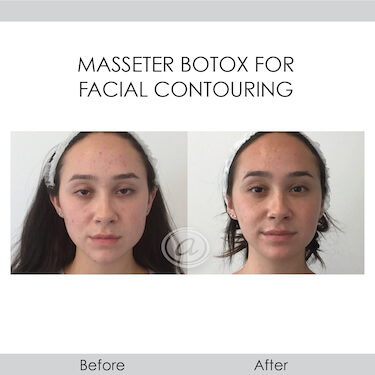before and after facial contouring front view female patient Redondo Beach