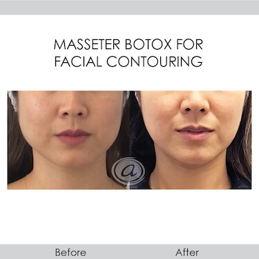 before and after masseter botox for facia contouring front view female patient Redondo Beach