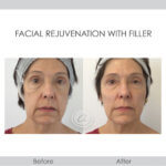 before and after rejuvenation with fillers front view female patient Redondo Beach