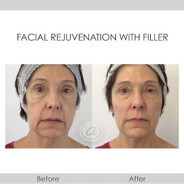 before and after rejuvenation with fillers front view female patient Redondo Beach