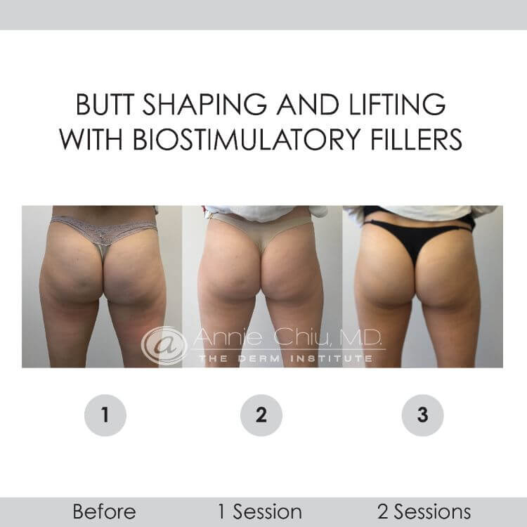 before and after butt shaping and lifting with bio stimulatory fillers back view female patient Redondo Beach