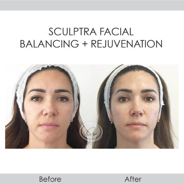 before and after sculptra facial balancing and rejuvenation front view female patient Redondo Beach