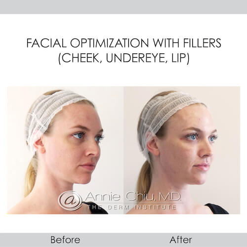 before and after facial optimization fillers right view female patient Redondo Beach