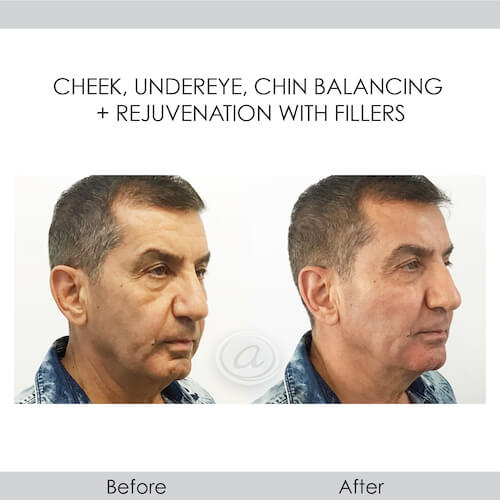 before and after rejuvenation fillers right view male patient Redondo Beach