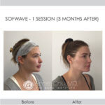 before and after sofwave right view female patient Redondo Beach