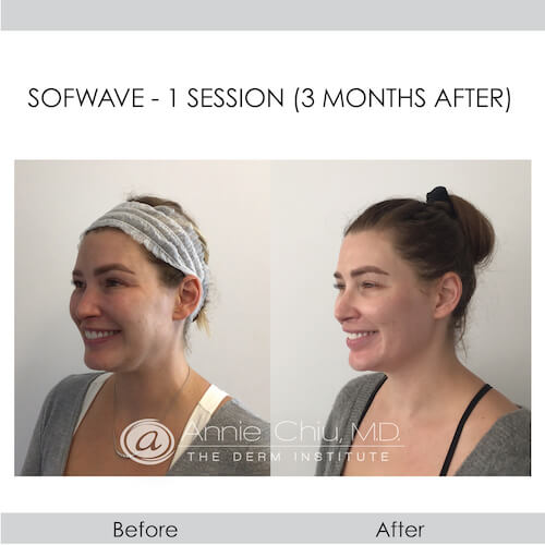 before and after sofwave left view female patient Redondo Beach