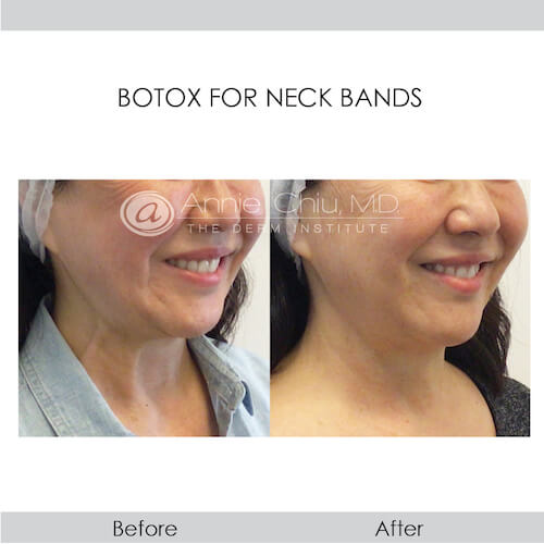 before and after botox for neck bands right view female patient Redondo Beach, CA