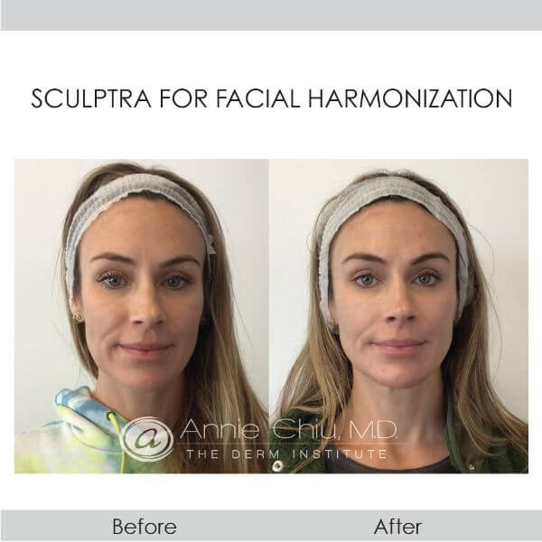before and after Sculptra front view female patient Redondo Beach, CA