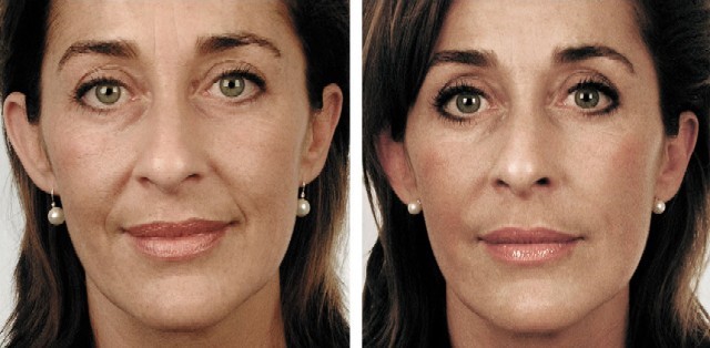 3 dimensional correction of the aging face 2