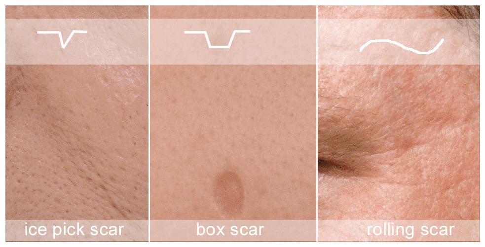 Scar Treatments: Types of Scars and Their Treatments - WebMD